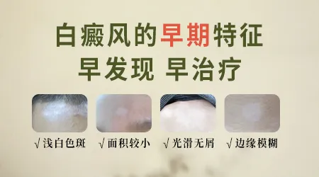 白癜风早期图片刚长出来的样子