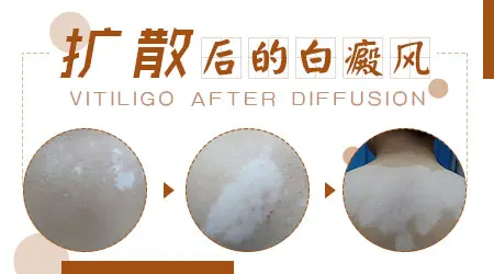 孩子脸上突然长了一块白怎么回事