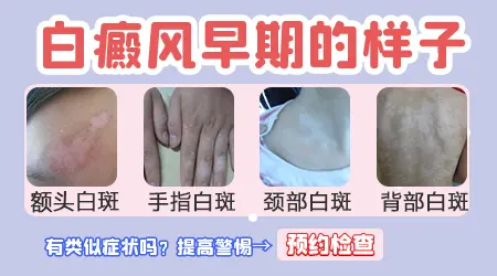 白癜风早期和其他白斑有什么区别图片对比