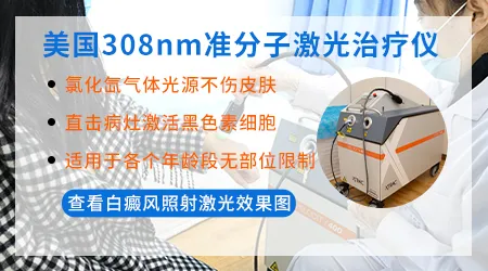 儿童眼皮上有白癜风能照308激光吗