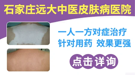 白斑和白癜风有什么不同图片区别