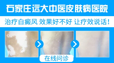 石家庄治疗白癜风康复案例多的医院是哪家