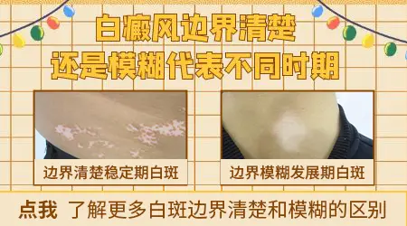 白癜风边界清晰和模糊各代表什么
