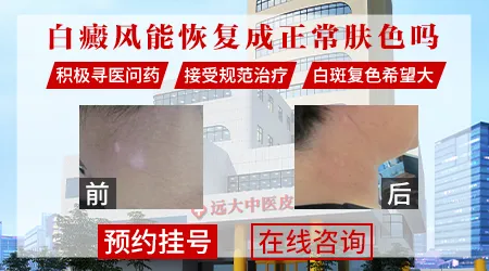 白癜风多年病史还能不能恢复