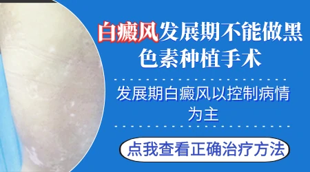 进展期白癜风可以做手术治疗吗