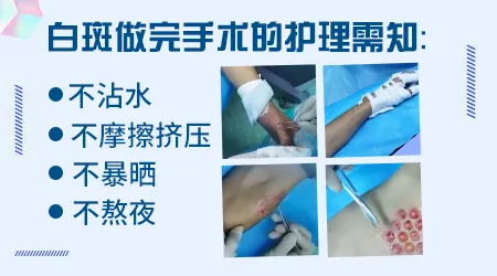 白癜风植皮手术之后会不会留下明显疤痕