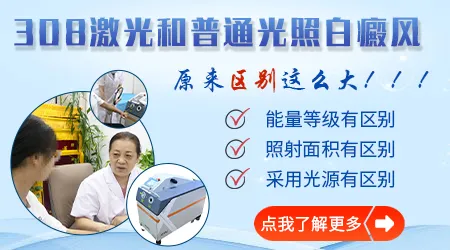 白癜风照308激光自己买仪器还是医院照
