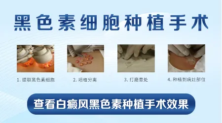 黑色素种植治疗白癜风好吗