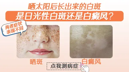军训暴晒后脸上长白点是不是白癜风