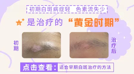 脸上刚开始长白癜风时什么样图片