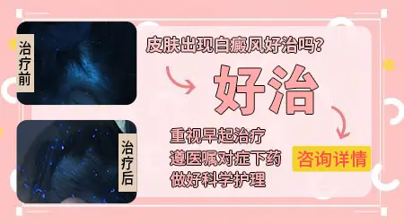 白癜风早期有什么症状图片