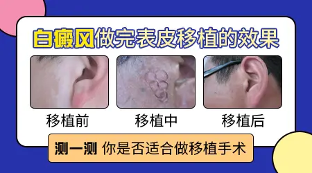 白癜风吸疱移植和黑色素种植一样吗