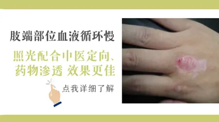 肢端型白癜风做308光疗有用吗