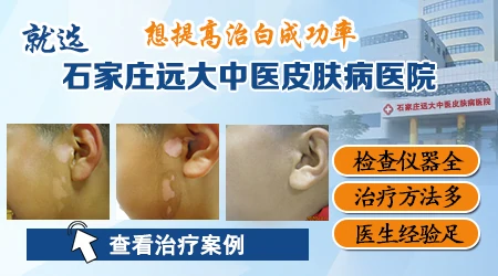 石家庄看白癜风去哪家医院靠谱