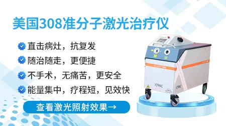 308激光治疗白癜风有没有治好的案例