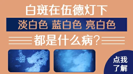 儿童脸上的白斑伍德灯下显示淡白色解读