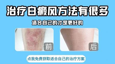 治疗白癜风好的方法是什么