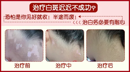 泛发性白癜风怎么治疗效果好