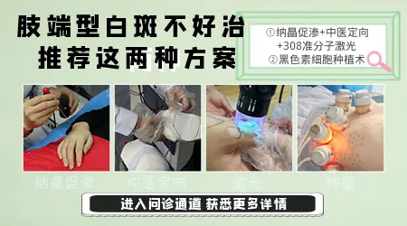 白癜风长在手上为什么恢复得慢