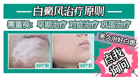 白癜风初期能不能除根