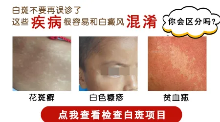 大腿上出现小白点会是白癜风的早期表现吗