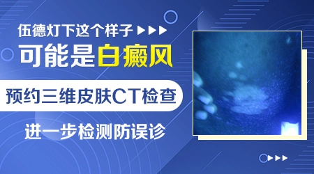 伍德灯下白斑呈灰白色是什么类型的白斑