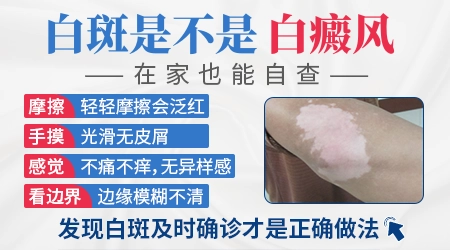 如何看白斑是不是白癜风图片