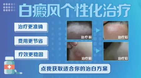 白癜风这个真的能治好吗