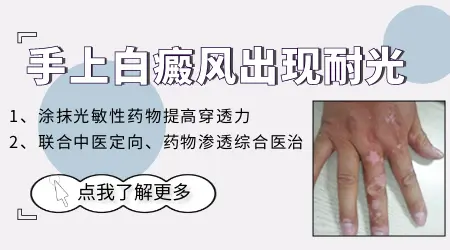 白癜风长期照激光会不会产生耐光性