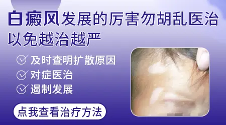 白癜风发展期一般会持续几个月