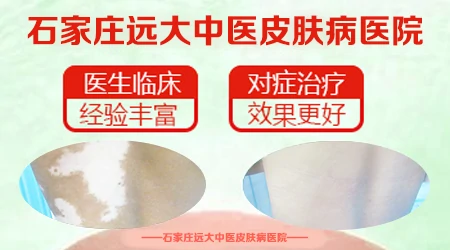 皮肤CT显示色素环不完整代表什么