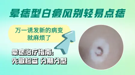 晕痣的白斑面积超过1厘米还能治好吗