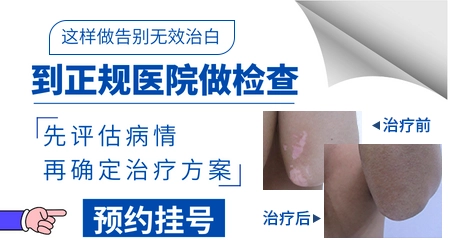 无色素痣和白癜风怎么分辨