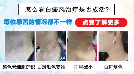 皮肤CT报告色素沉着不均代表病情怎么样