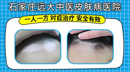 治疗白癜风有效的方法是什么