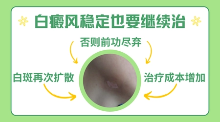 早期白癜风做植皮手术合适吗