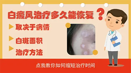 白癜风一般做几次点阵激光能治好