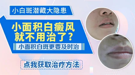 白癜风早期面积小不管不顾可以吗