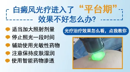 白癜风长期照激光会不会产生耐光性