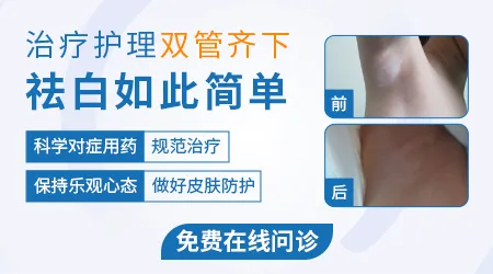 石家庄哪家医院比较擅长治皮肤白斑