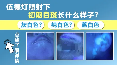白斑在伍德灯下是灰白色荧光代表什么