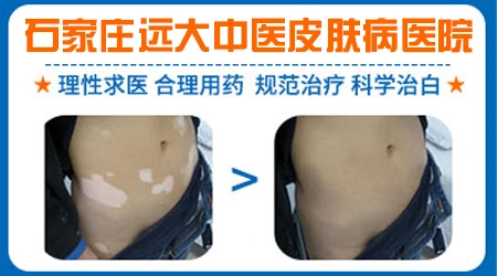 石家庄哪里能打白癜风复色针
