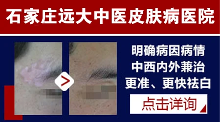 石家庄哪里的中医看白癜风好