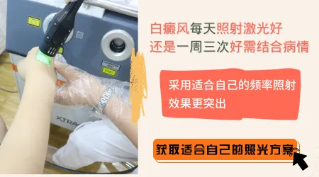 石家庄照308准分子激光价格一般多少