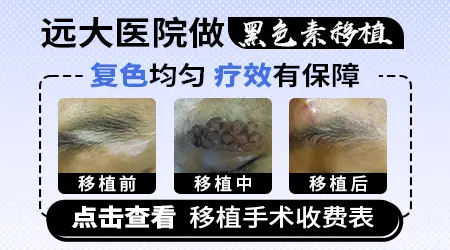 石家庄做白癜风表皮移植手术哪家医院好