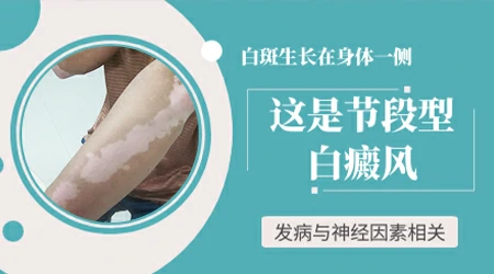 身上单侧长白斑是节段型吗