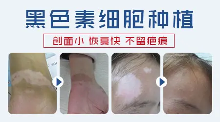 白癜风种植后取皮的地方会留疤吗