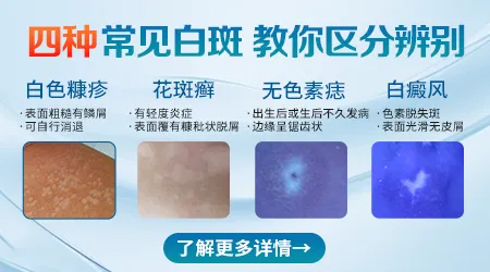 如何辨别孩子脸上的白斑是白癜风还是其他皮肤病