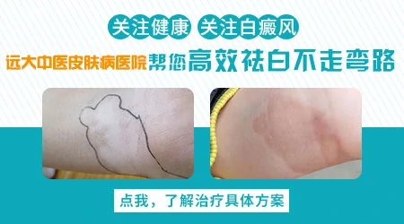 石家庄哪家医院皮肤科治白癜风好