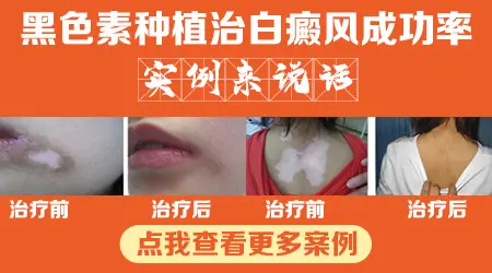 自体表皮移植治疗白癜风成功率高吗 会不会留疤
